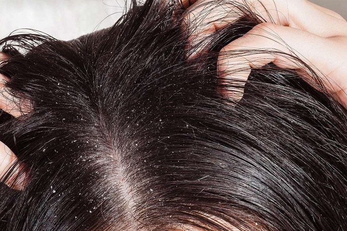 شوره سر پس از کراتین مو به چه علت است؟ + درمان