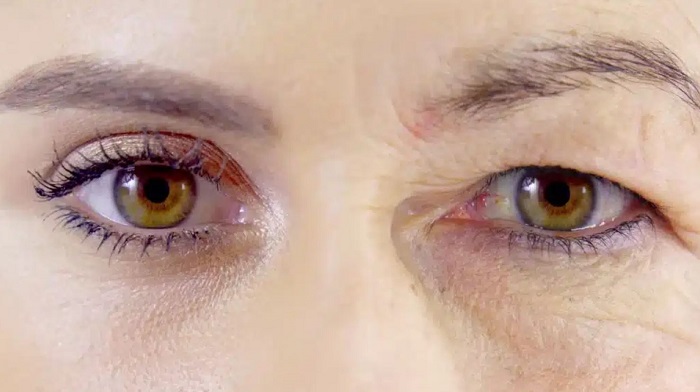 مشکل افتادگی پلک چیست؟ مشکل افتادگی پلک چیست؟